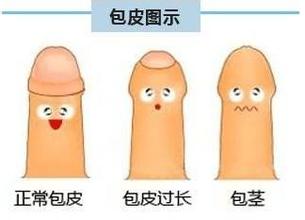 怎样判断是否是包皮包茎？