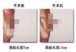 医生介绍阴茎短小怎样延长! 医生介绍阴茎短小怎样延长!