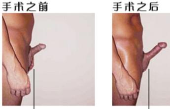 河池欧式阴茎延长术多少钱呢? 河池欧式阴茎延长术多少钱呢?