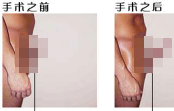 男性阴茎短小会危害患者吗? 男性阴茎短小会危害患者吗?