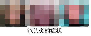 阴茎冠状沟会有哪些异常症状? 阴茎冠状沟会有哪些异常症状?