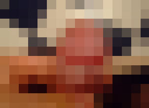 河池包皮红肿? 河池包皮红肿?